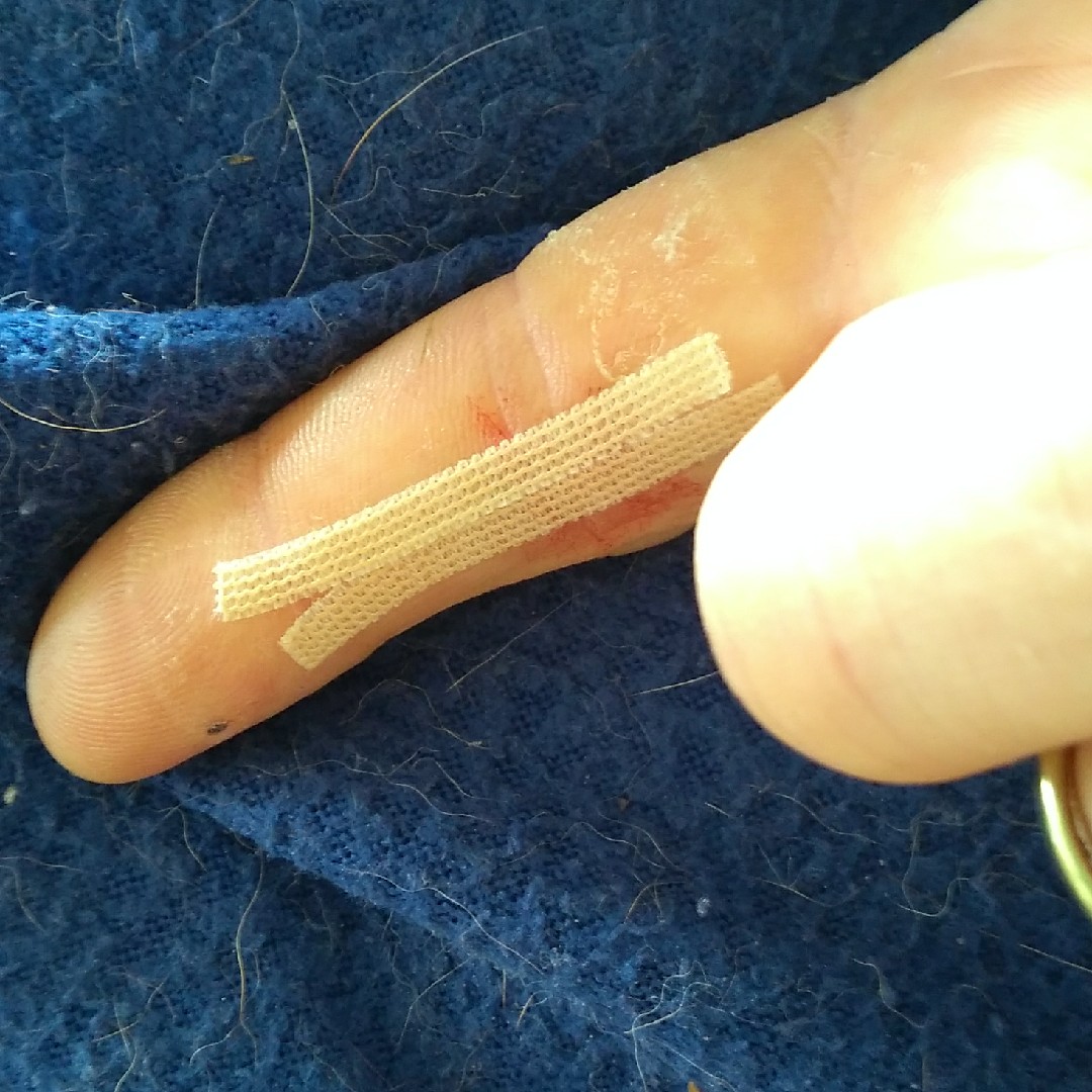 Steristrips auf gesuberter, kaum sichtbarer Wunde.